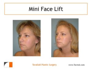 Young woman before after mini facelift oblique view