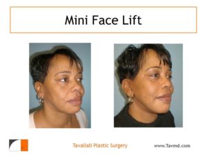 Mini facelift surgery results in black woman