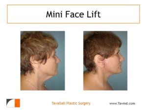 Neck & Jowl lift surgery in woman