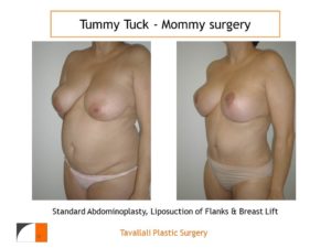 Mommy Surgery Tummy tuck and Breast lift before after