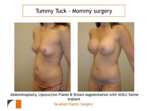 Mommy Surgery Tummy tuck and Breast augmentation 420 cc saline implant