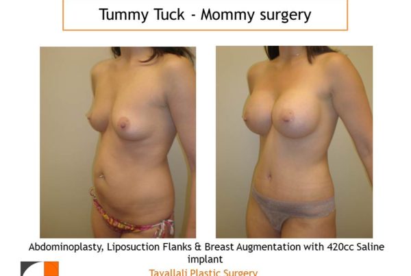 Mommy Surgery Tummy tuck and Breast augmentation 420 cc saline implant