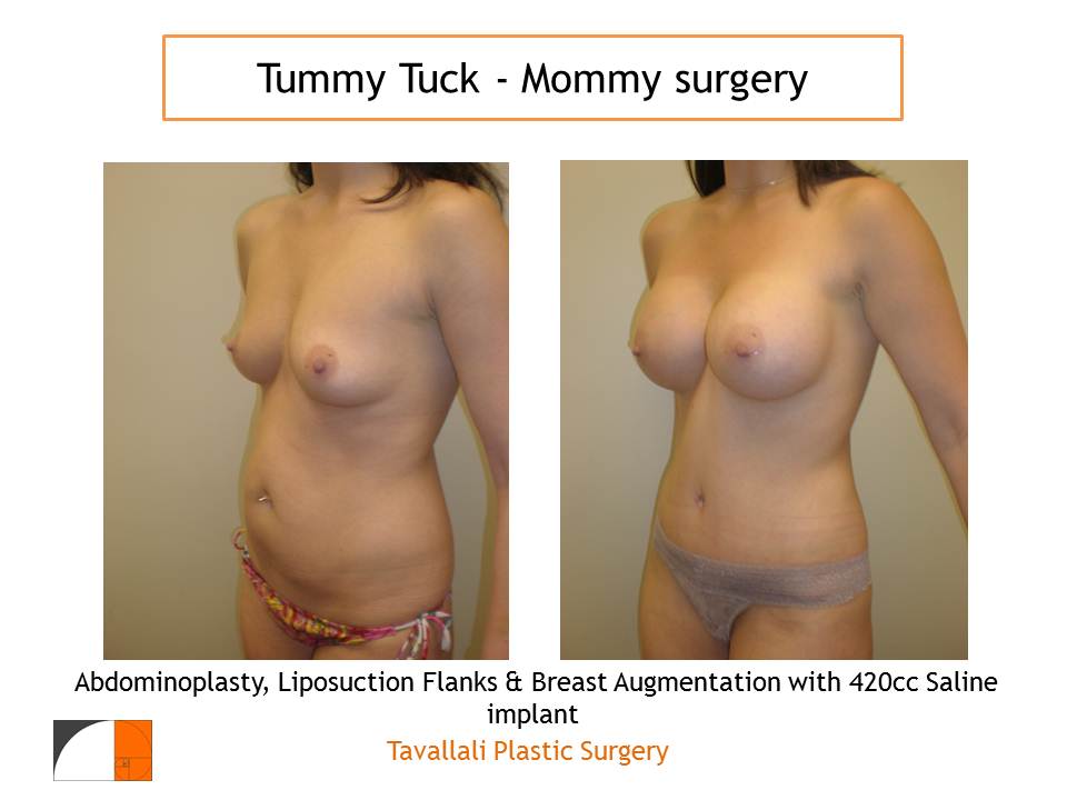 Only 12 hours after a “Mommy surgery” tummy tuck and breast surgery Tavallali plastic surgery patient