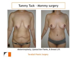 Mommy Surgery Tummy tuck and Breast lift result