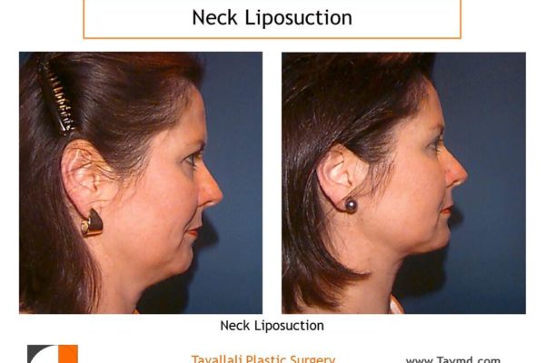 Side view before after neck liposuction Fairfax county VA