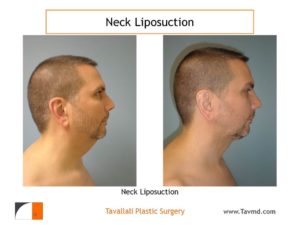 Man with before after neck liposuction surgery