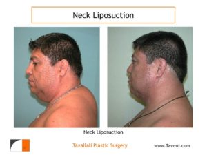 Neck liposuction fat removal before after Virginia in Man