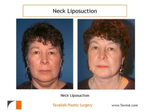 Neck liposuction fat removal before after Virginia