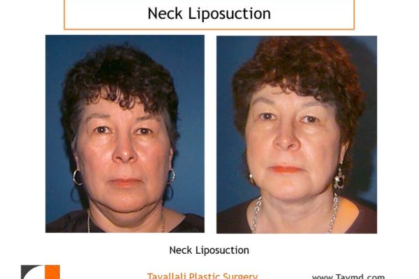 Neck liposuction fat removal before after Virginia