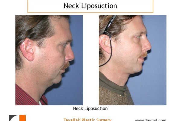Profile view before after neck liposuction Fairfax county VA