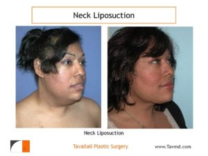 Large Neck liposuction fat removal before after