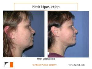 Neck liposuction fat removal before after