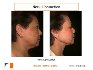 Neck liposuction fat removal before after