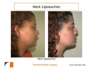 Profile Neck liposuction to remove neck fat before after