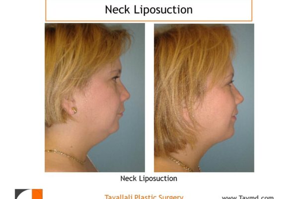 Neck liposuction to remove neck fat before after