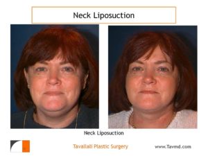Front view before after neck liposuction Fairfax county VA