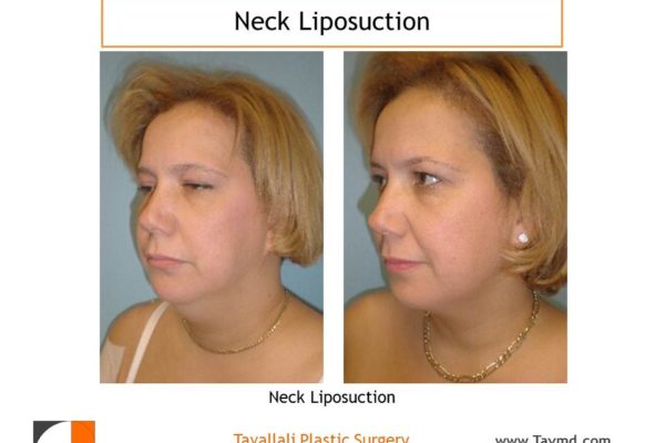 Neck liposuction to remove neck fat before after