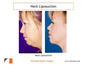 Profile view woman with neck liposuction