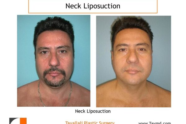 front view Neck liposuction surgery in man before after result