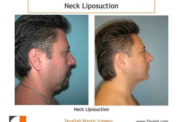 Neck liposuction surgery in man before after result