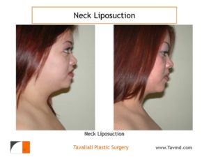Neck lipo surgery in woman before after result