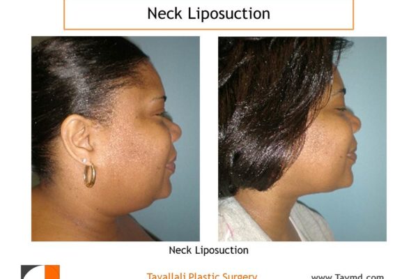 Neck liposuction surgery result before after