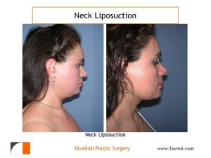 Neck liposuction before & after Vienna VA