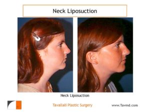 before after neck liposuction surgery young girl