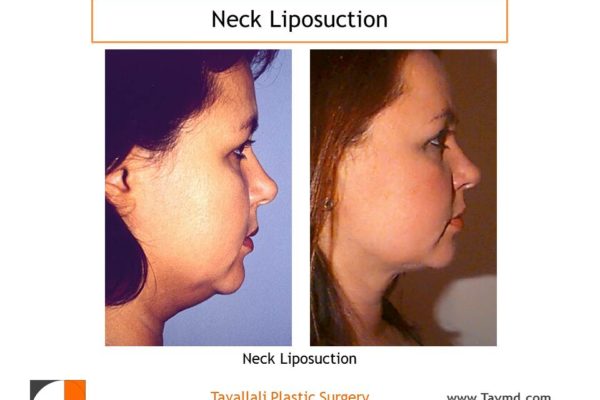 before after neck liposuction surgery