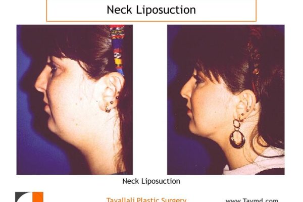 Woman with before after neck liposuction surgery