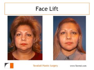 Before after facelift surgery result of woman