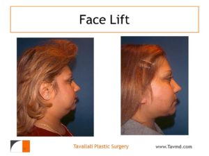 Facelift surgery results Vienna VA