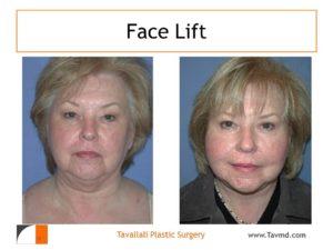 Before after face lift of woman in Virginia