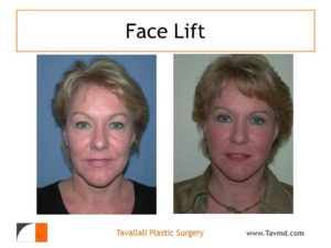 Before and after facelift by Dr. Tavallali
