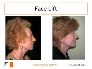 Face lift surgery results in vA