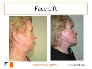 Face lift surgery before after in VA