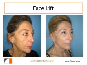 Facelift before after Vienna Virginia