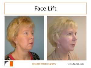 Face lift surgery before after of woman