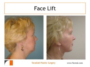 Face lift before after