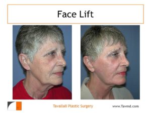 Facelift surgery before after