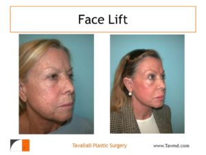 Before and after of Facelift