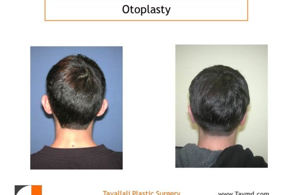Otoplasty Before & After in man