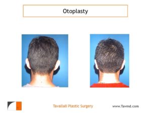 Otoplasty Ear Pinning before after