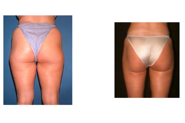 Thigh liposuction before & after Fairfax county VA