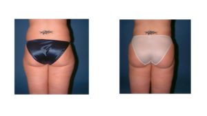 Hip and outer thigh liposuction surgery results