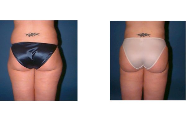 Hip and outer thigh liposuction surgery results