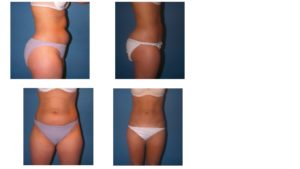 Liposuction outer thighs abdomen and hips