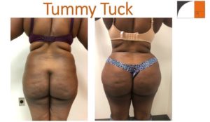 Abdominoplasty and liposuction flanks before after