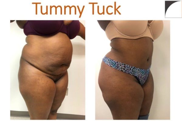 Larger woman with Tummy tuck abdominoplasty before after