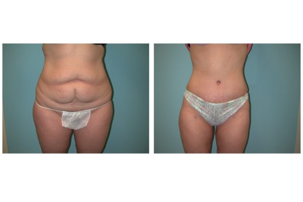 Tummy tuck abdominoplasty before after woman with midline scar